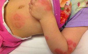 child with bed bug bites