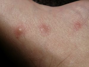 Mosquito bites that itch