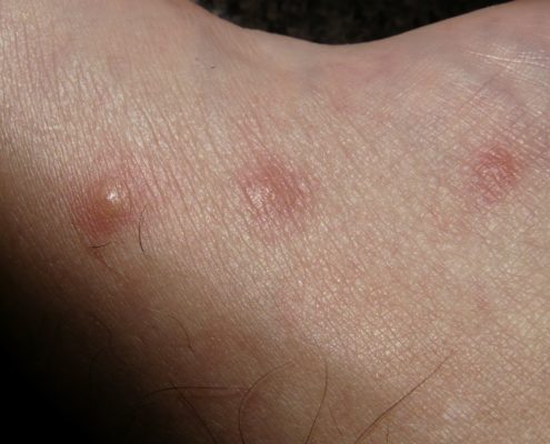 Mosquito bites that itch
