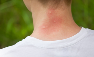 mosquito bites on neck